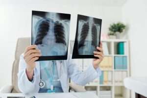 Doctor comparing lungs x-rays for lung cancer screening
